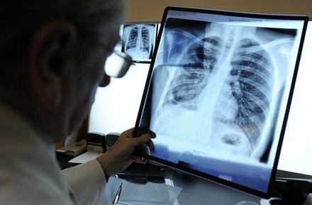 Главный фтизиатр Минздрава предупредила о возможном всплеске туберкулёза из-за пандемии коронавируса