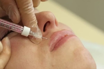Косметолог предупредила о смертельных последствиях самостоятельного увеличения губ 