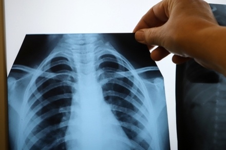 В Минздраве констатировали рост заболеваемости туберкулёзом в России